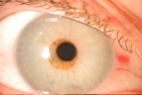 Lente intraocular que cambia el color del ojo Aspecto in situ del dispositivo que cambiaba el color del ojo