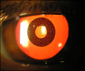 ACI CORNEAL INLAY con la pupila dilatada