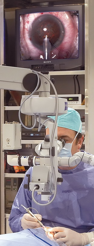 Dr. Soler operando cataratas