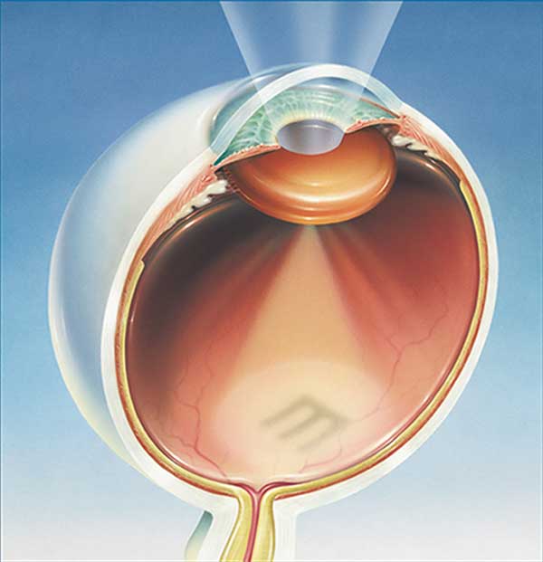 Ojo Con Cataratas Blog De Ojos Innova Ocular Clínica Dr Soler 4522