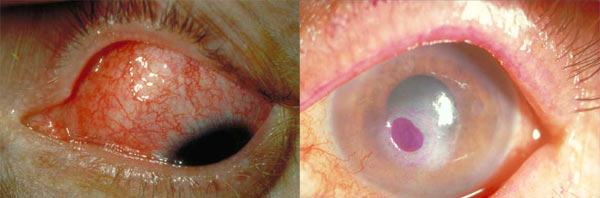 Los problemas que puede causar el oculolinctus van de una simple conjuntivitis a una úlcera corneal
