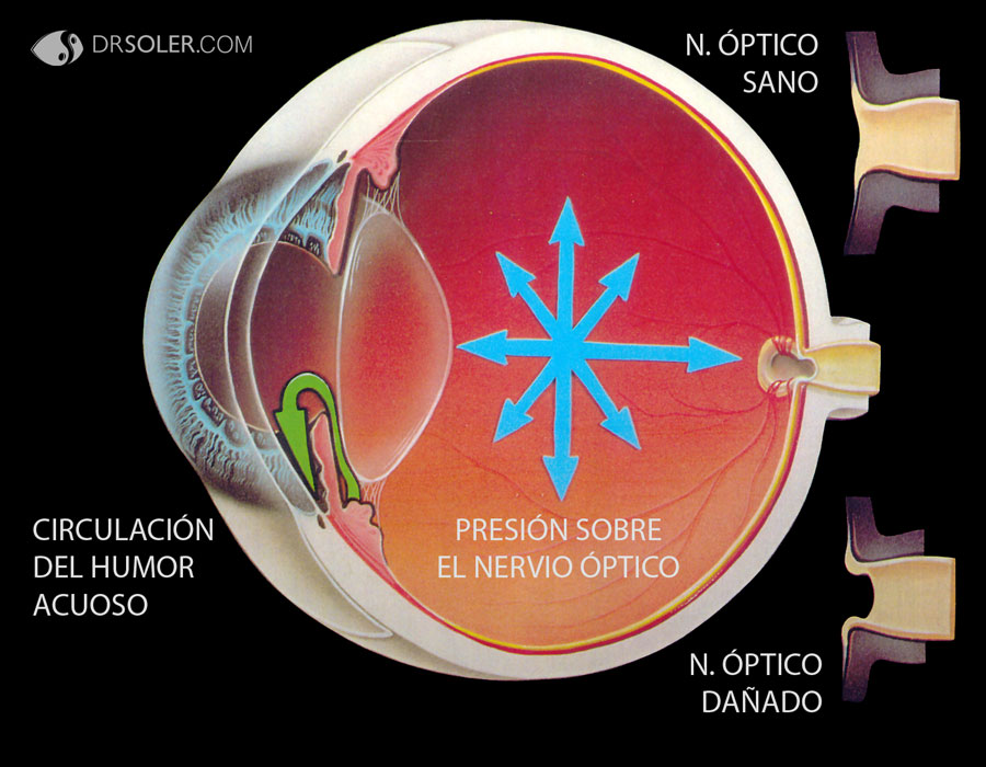 Qué Es El Glaucoma Blog De Ojos Innova Ocular Clínica Dr Soler 0013