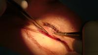 Cirugía oculoplástica, el arte de cuidar la mirada